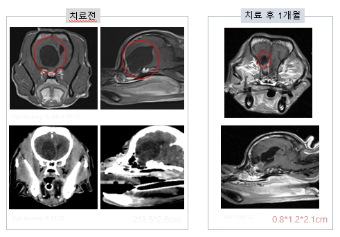 뇌종양 방사선 치료사례
